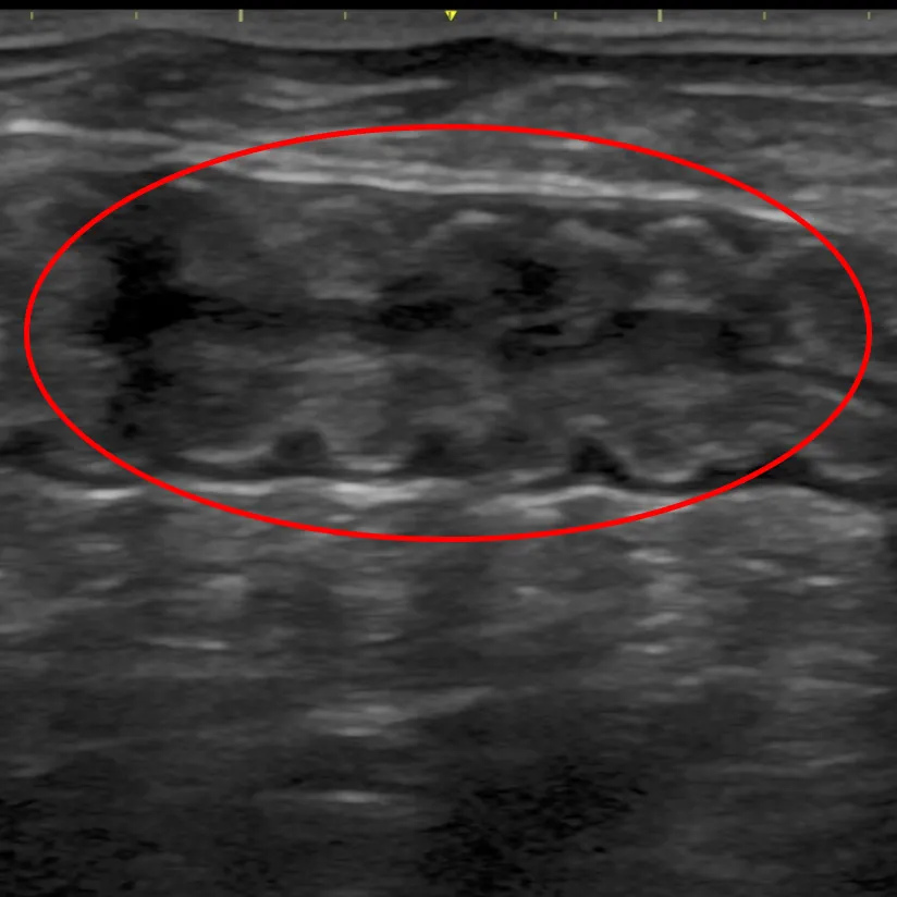 急性胃腸炎のイメージ画像