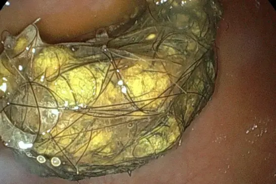 偶発的に胃内異物を併発していた蛋白漏出性腸症（PLE）の症例のサムネイル画像