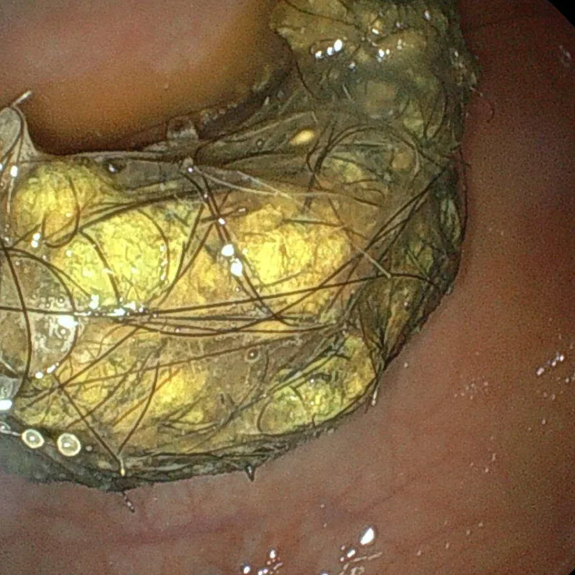 異物除去のイメージ画像