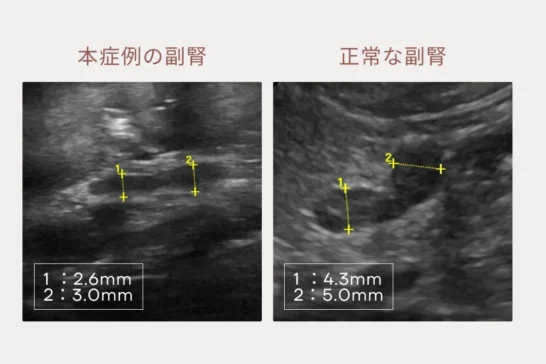 非定型アジソン病の症例のサムネイル画像