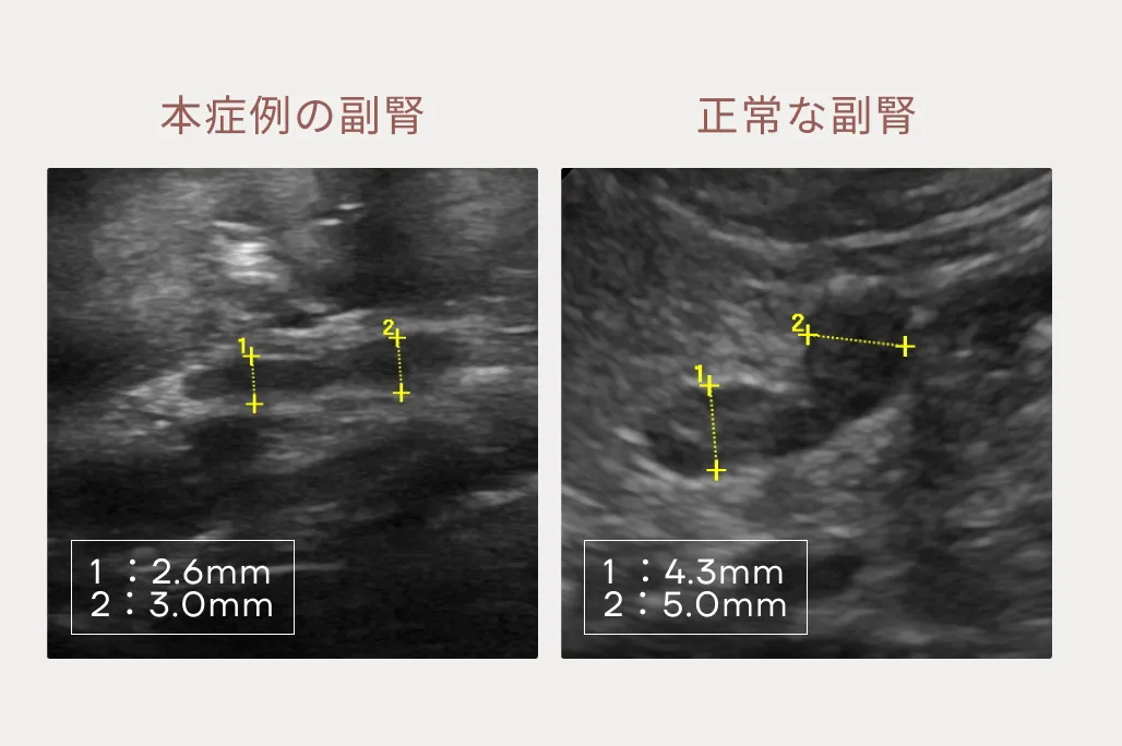 非定型アジソン病の症例のサムネイル画像