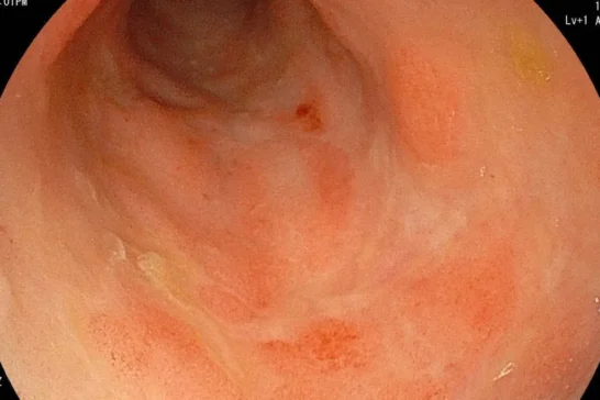 胃腸リンパ腫による蛋白漏出性腸症（PLE）の症例のサムネイル画像