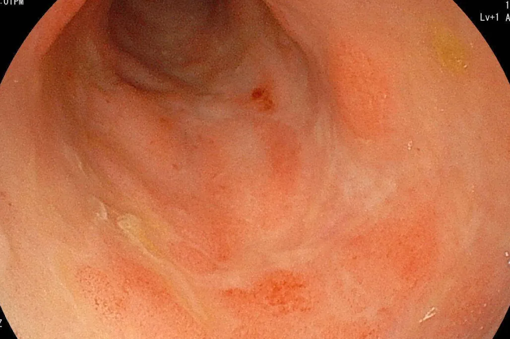 胃腸リンパ腫による蛋白漏出性腸症（PLE）の症例のサムネイル画像