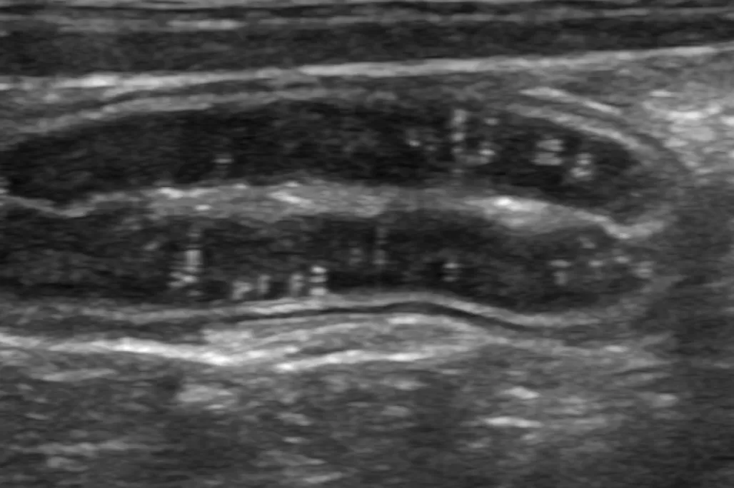無症状の蛋白漏出性腸症（PLE）を疑う症例（歯科から転科）のサムネイル画像