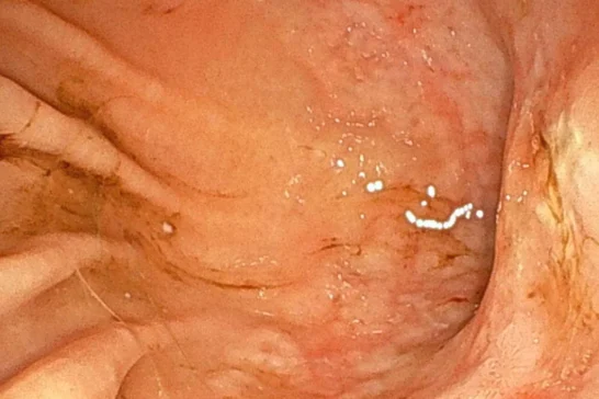 猫の胃リンパ腫の一例のサムネイル画像