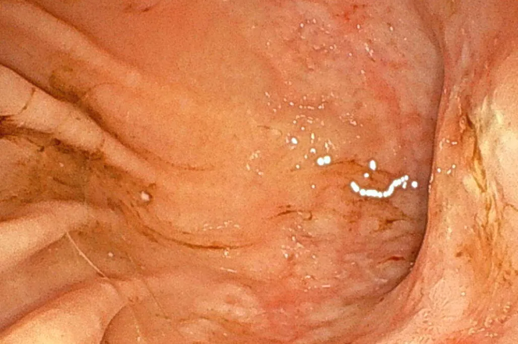 猫の胃リンパ腫の一例のサムネイル画像