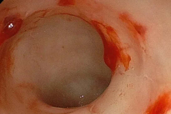 猫の短結腸症候群の一例のサムネイル画像