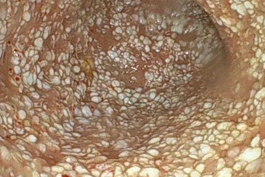 蛋白漏出性腸症（PLE）と慢性腎臓病を併発している一例のサムネイル画像
