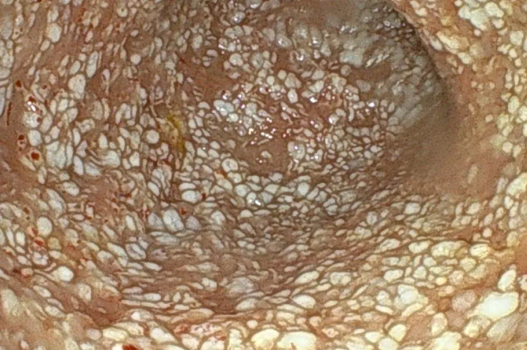 蛋白漏出性腸症（PLE）と慢性腎臓病を併発している一例のサムネイル画像